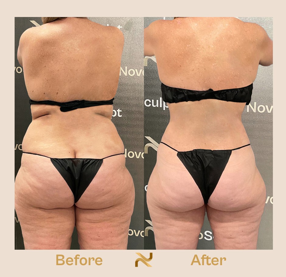 Novosculpt Before & After 1