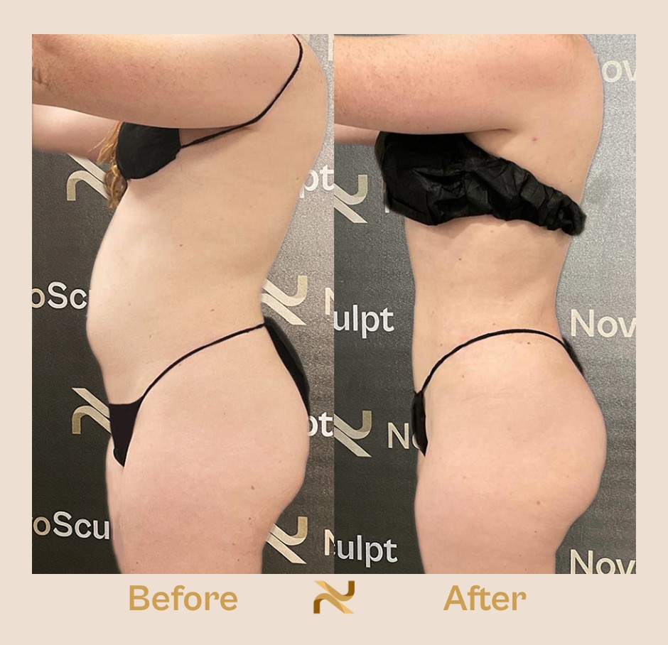 Novosculpt Before & After 10