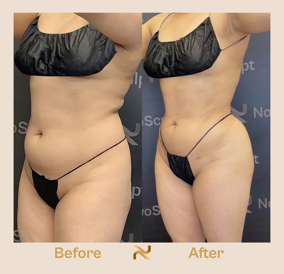 Novosculpt Before & After 11