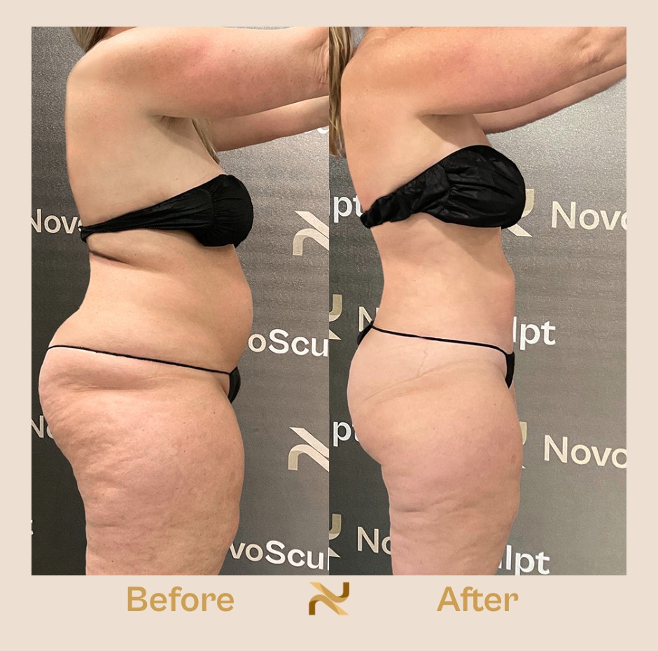 Novosculpt Before & After 12