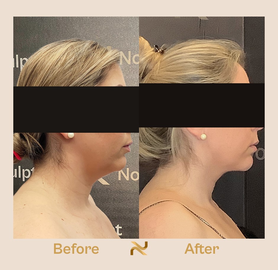 Novosculpt Before & After 13