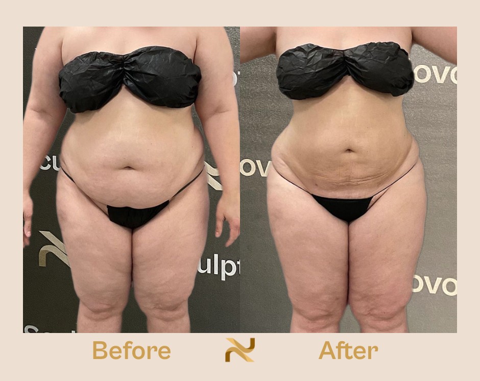 Novosculpt Before & After 14