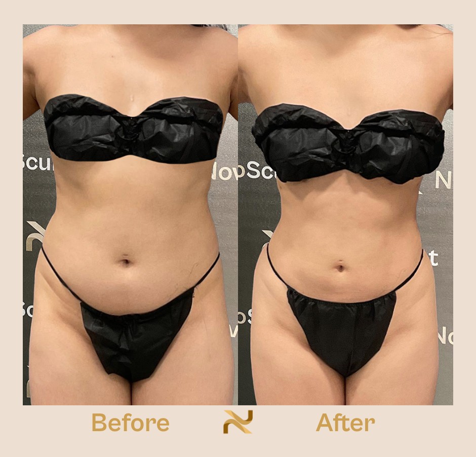 Novosculpt Before & After 15