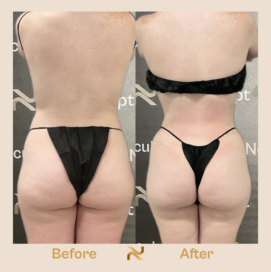 Novosculpt Before & After 16