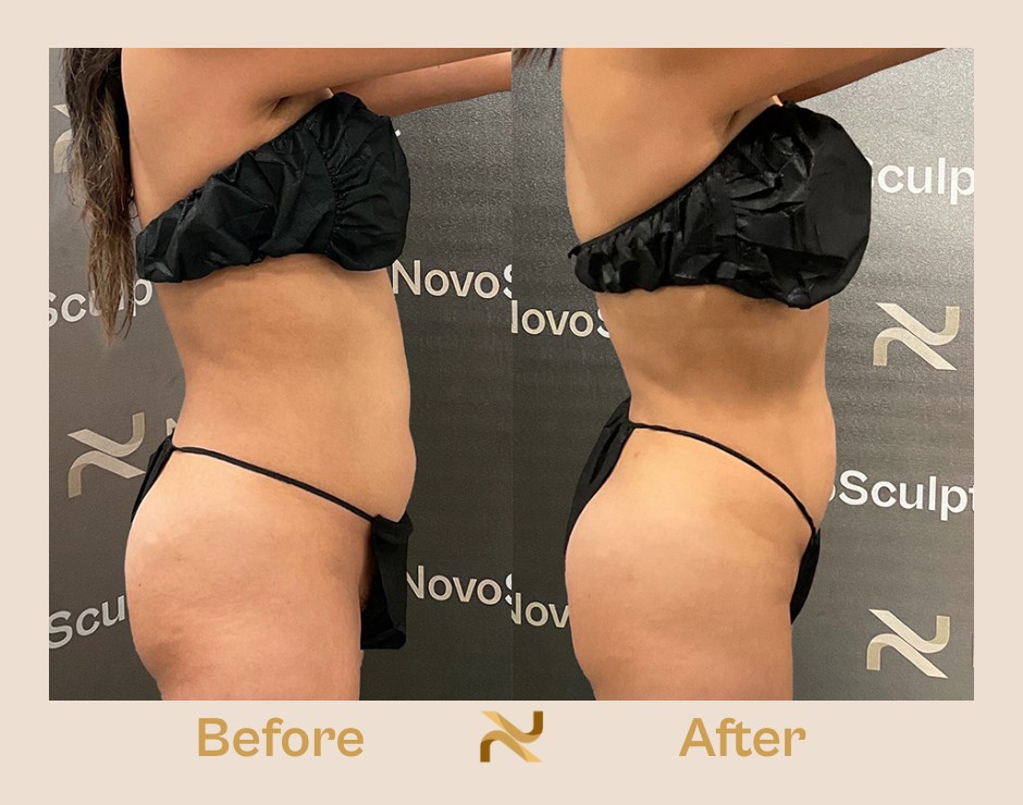 Novosculpt Before & After 17