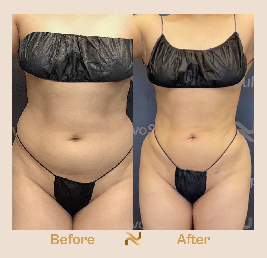 Novosculpt Before & After 19