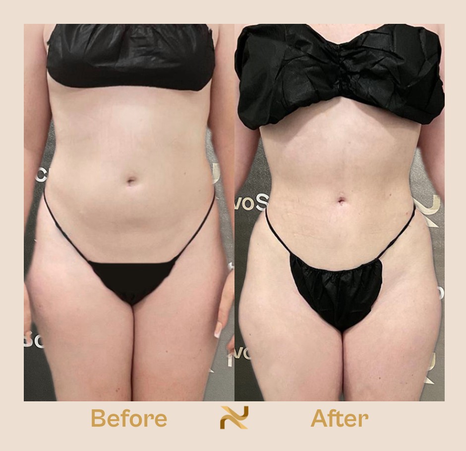 Novosculpt Before & After 2