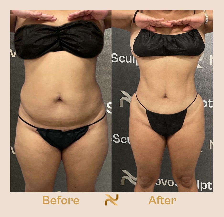 Novosculpt Before & After 20