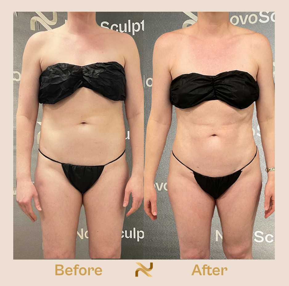 Novosculpt Before & After 21