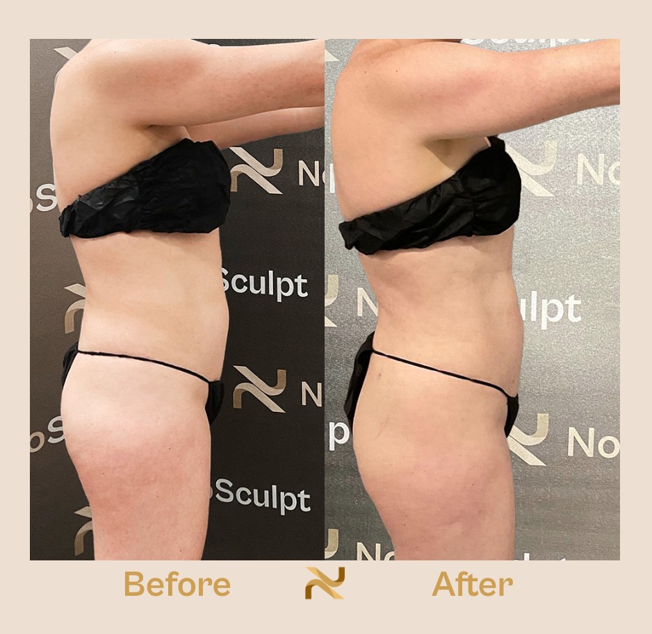 Novosculpt Before & After 22