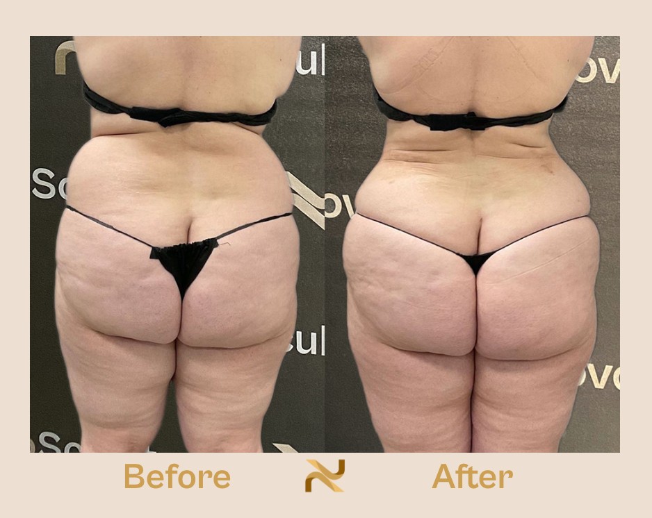 Novosculpt Before & After 23