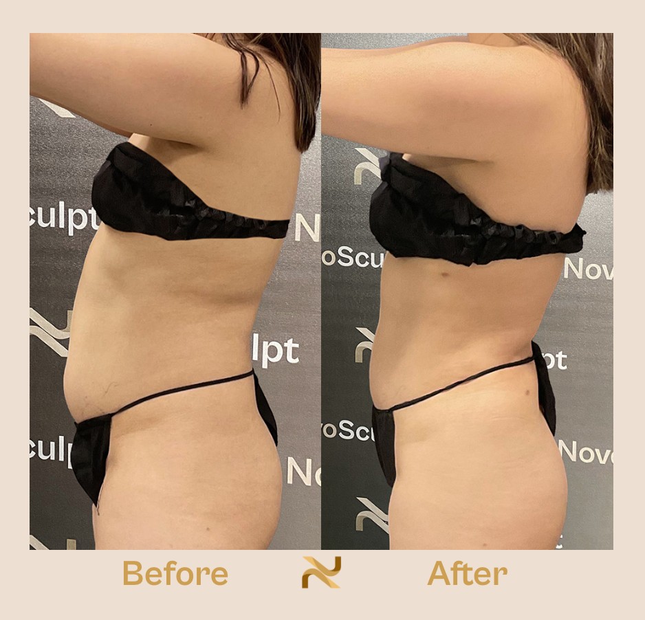 Novosculpt Before & After 24