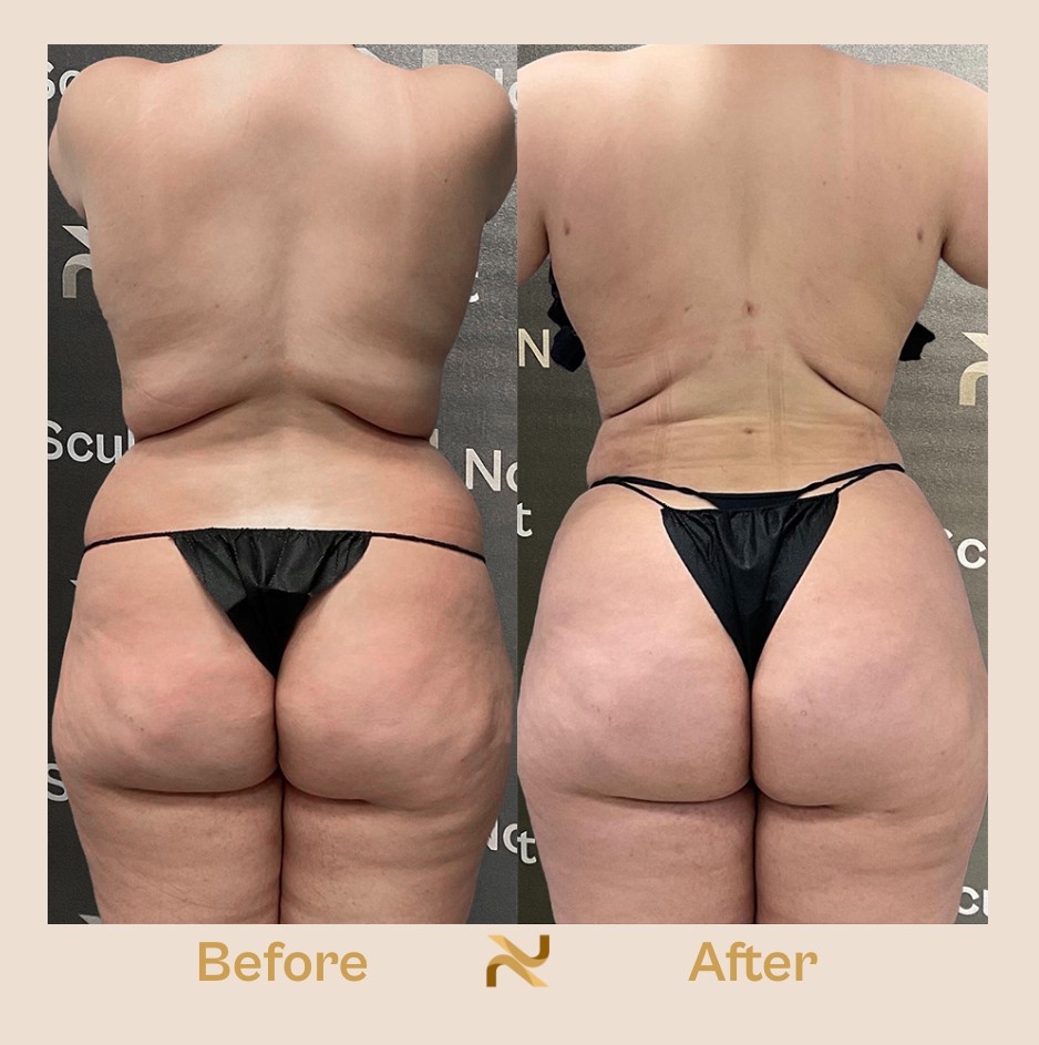 Novosculpt Before & After 25