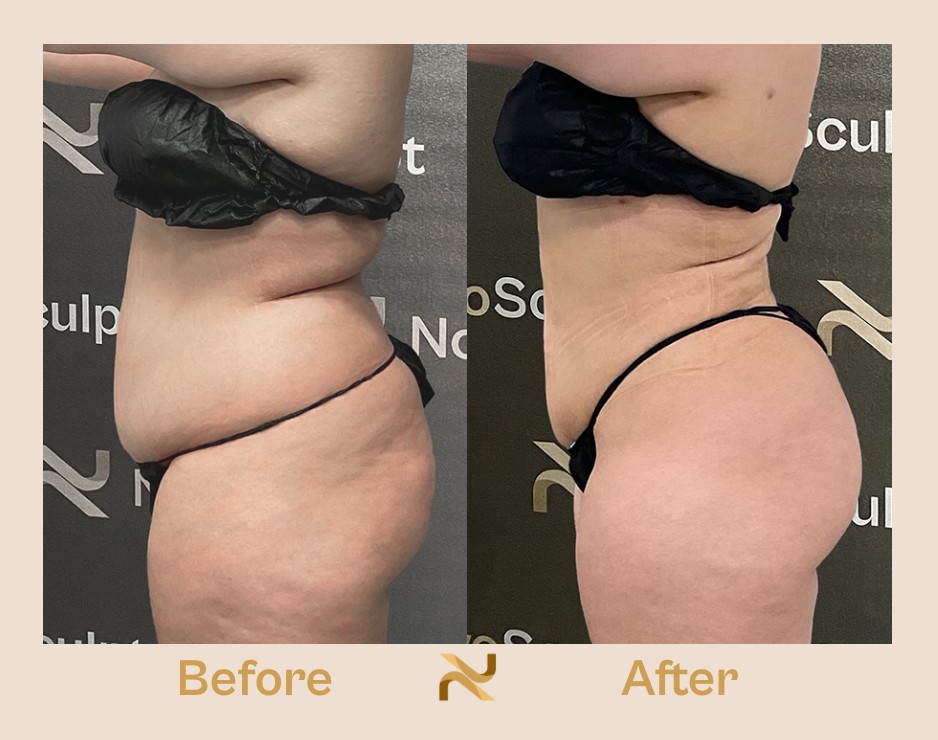 Novosculpt Before & After 26