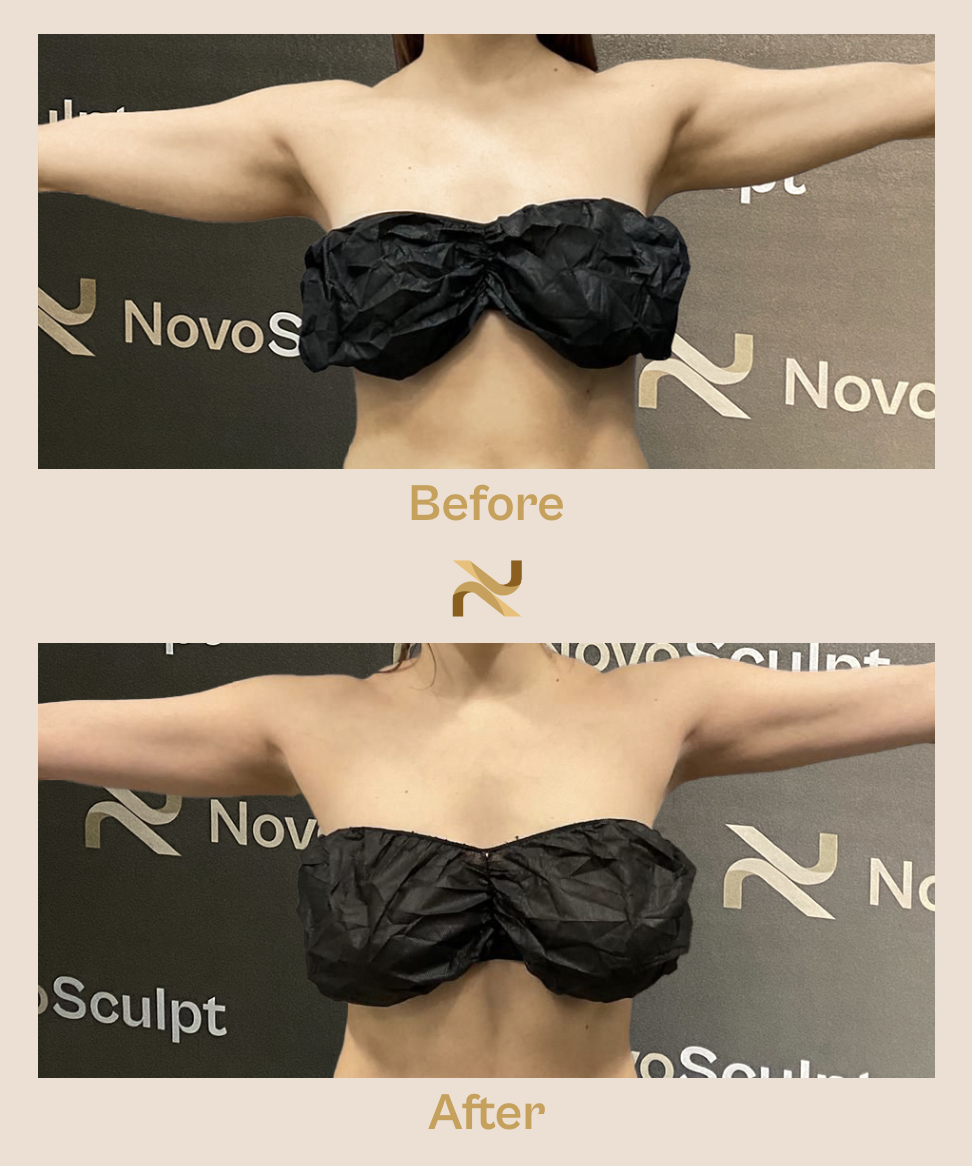 Novosculpt Before & After 27