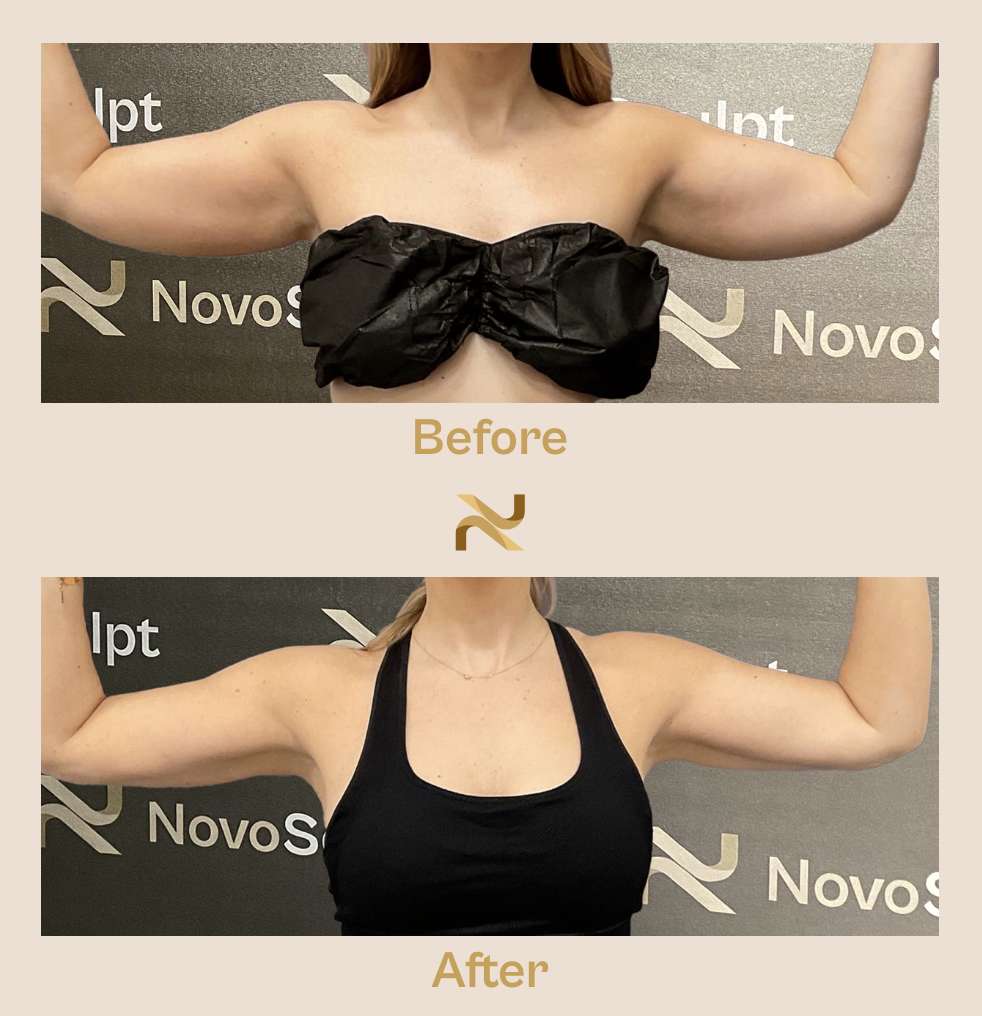 Novosculpt Before & After 28