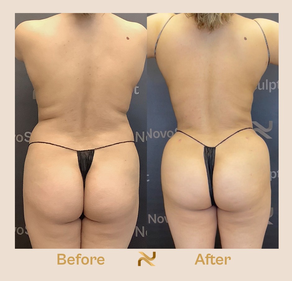 Novosculpt Before & After 3