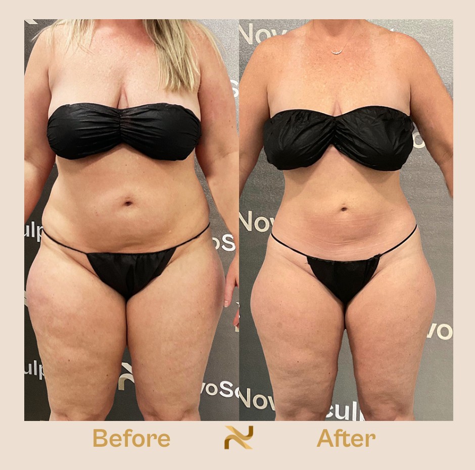 Novosculpt Before & After 4