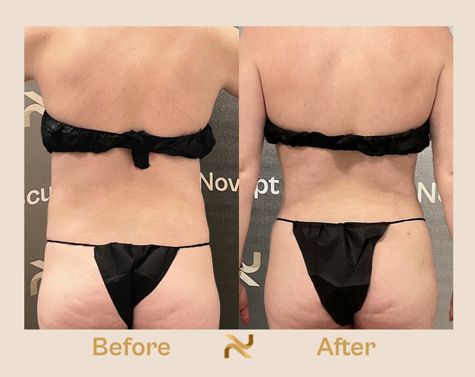 Novosculpt Before & After 5