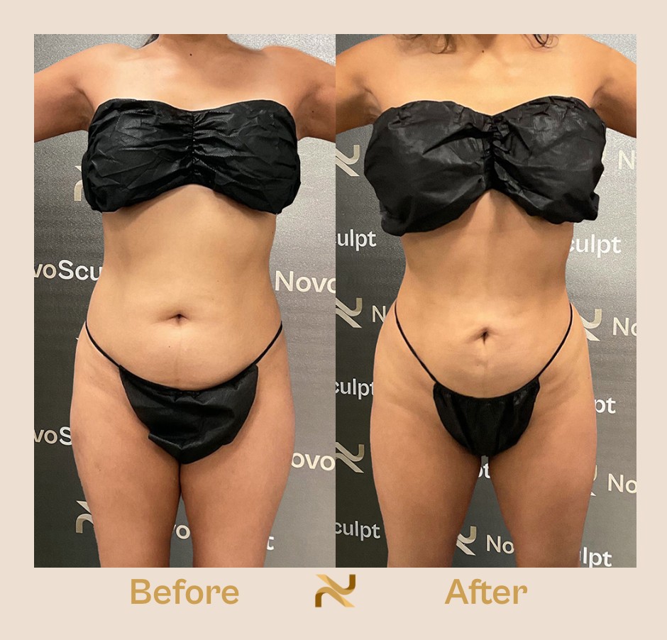 Novosculpt Before & After 6