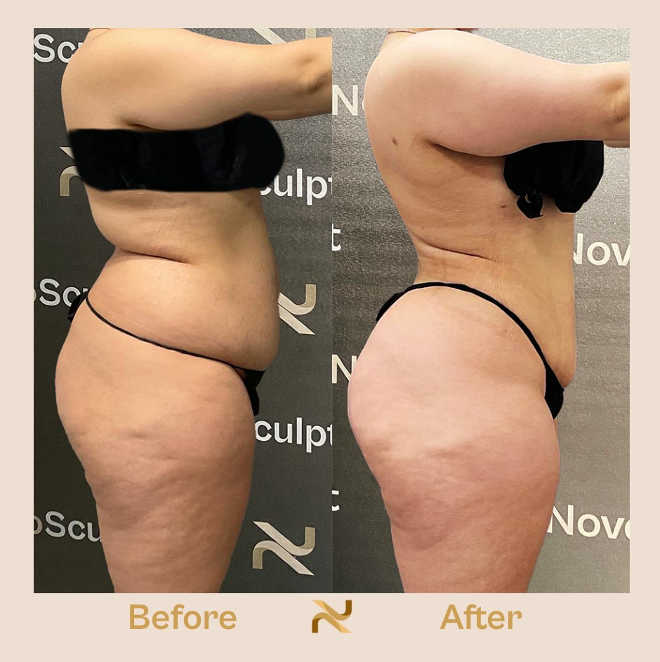 Novosculpt Before & After 7