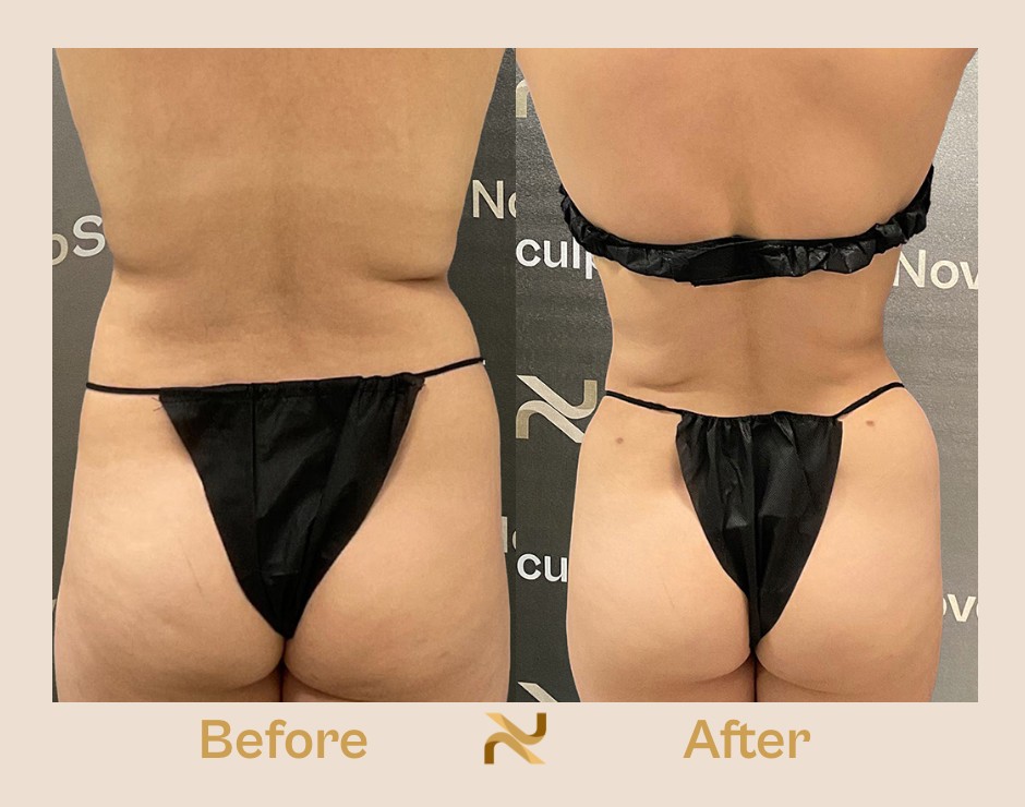 Novosculpt Before & After 8