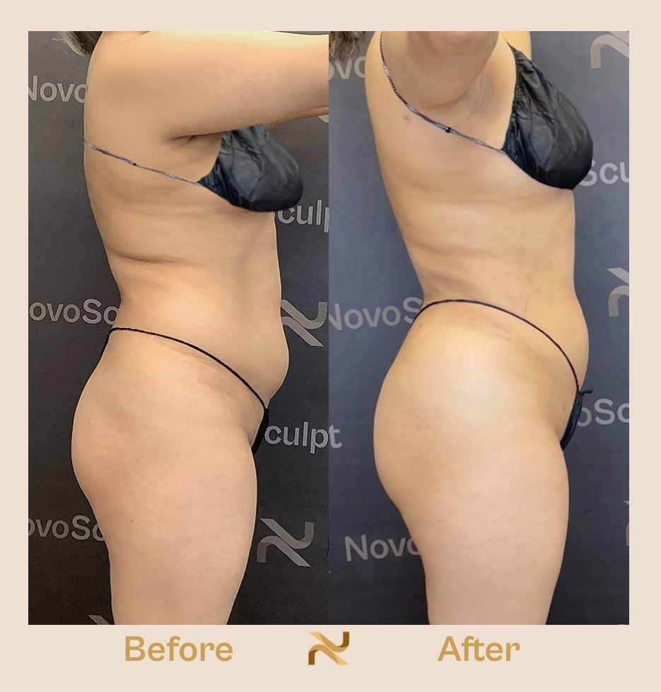 Novosculpt Before & After 9