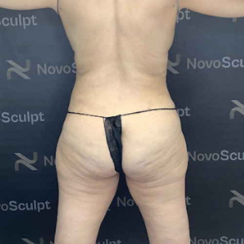before-after-stomach-3-b-new