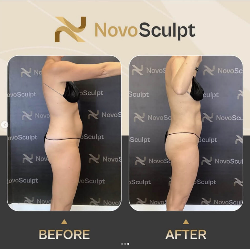 Before and After NovoSculpt