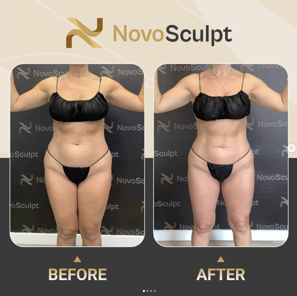 Before and After NovoSculpt