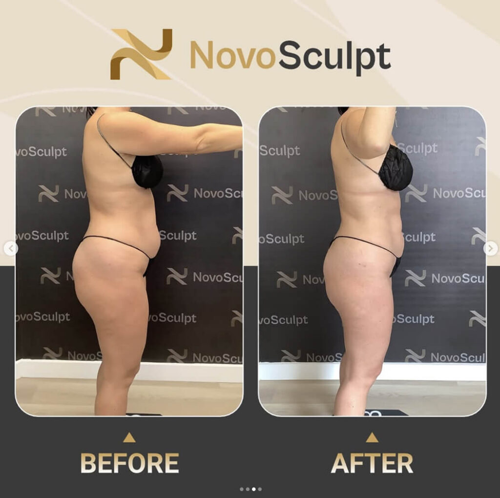 Before and After NovoSculpt