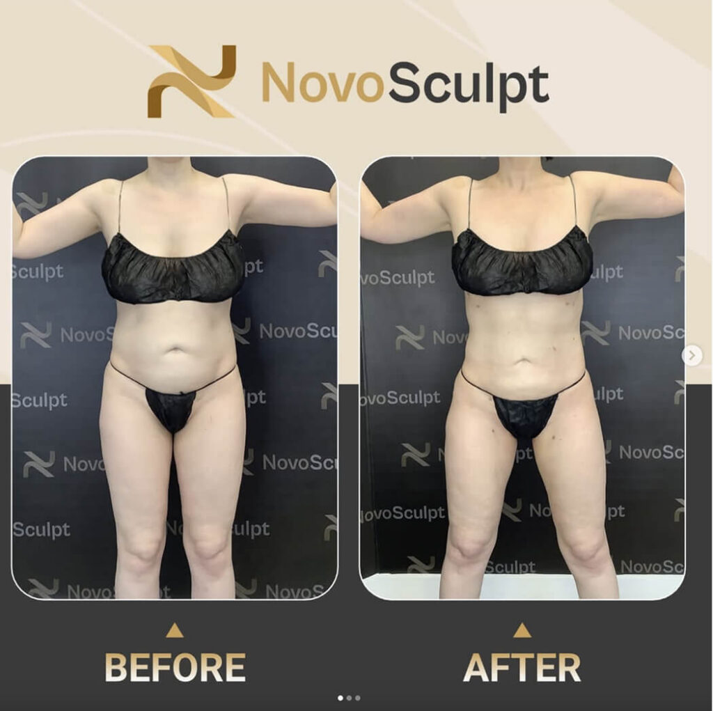 Before and After NovoSculpt