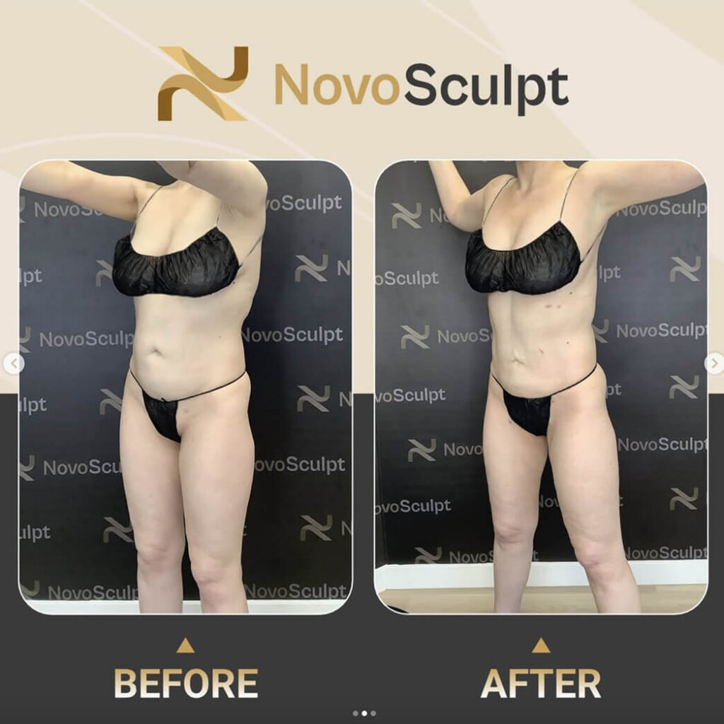 Before and After NovoSculpt