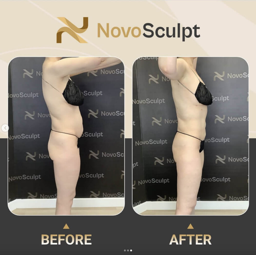 Before and After NovoSculpt