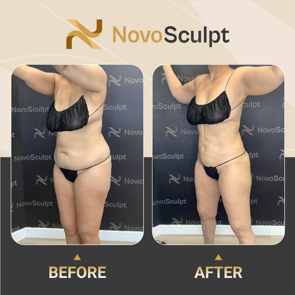 Before and After NovoSculpt