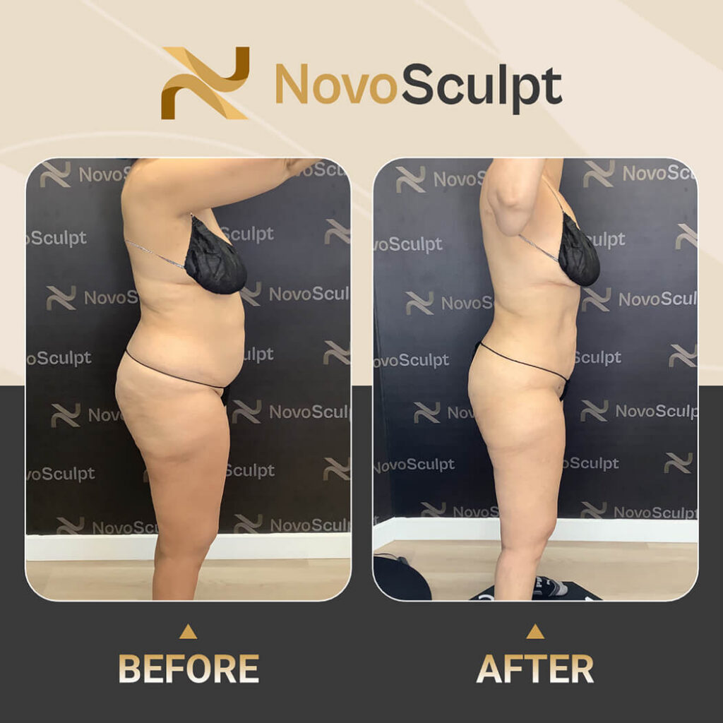Before and After NovoSculpt