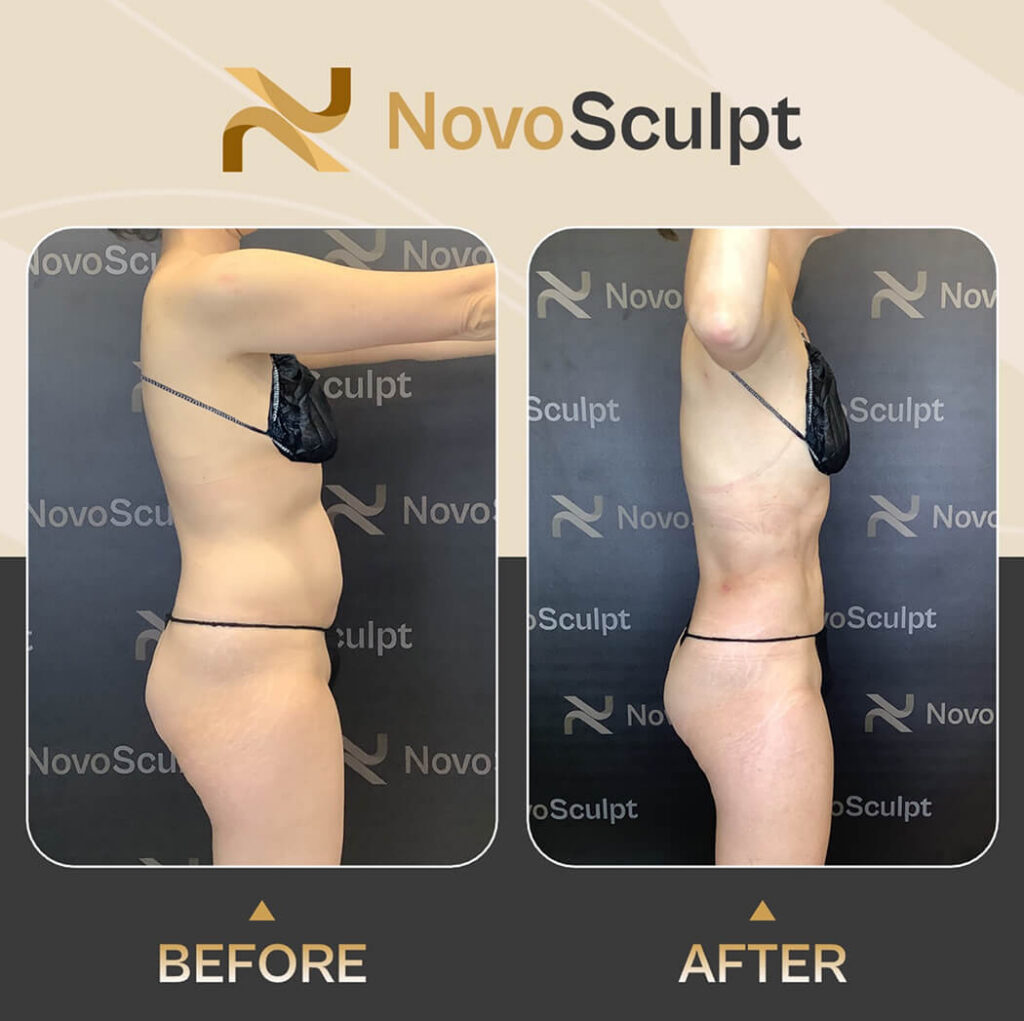 Before and After Side