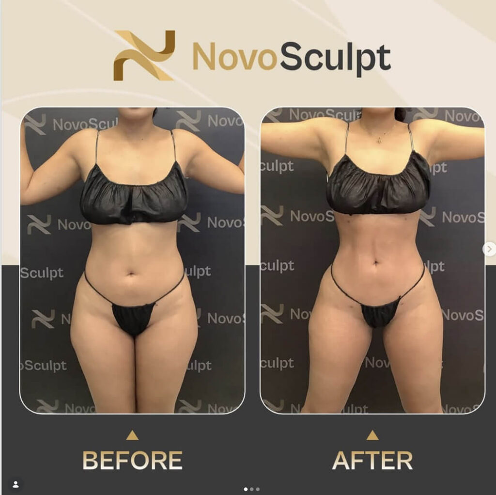 Before After Thin