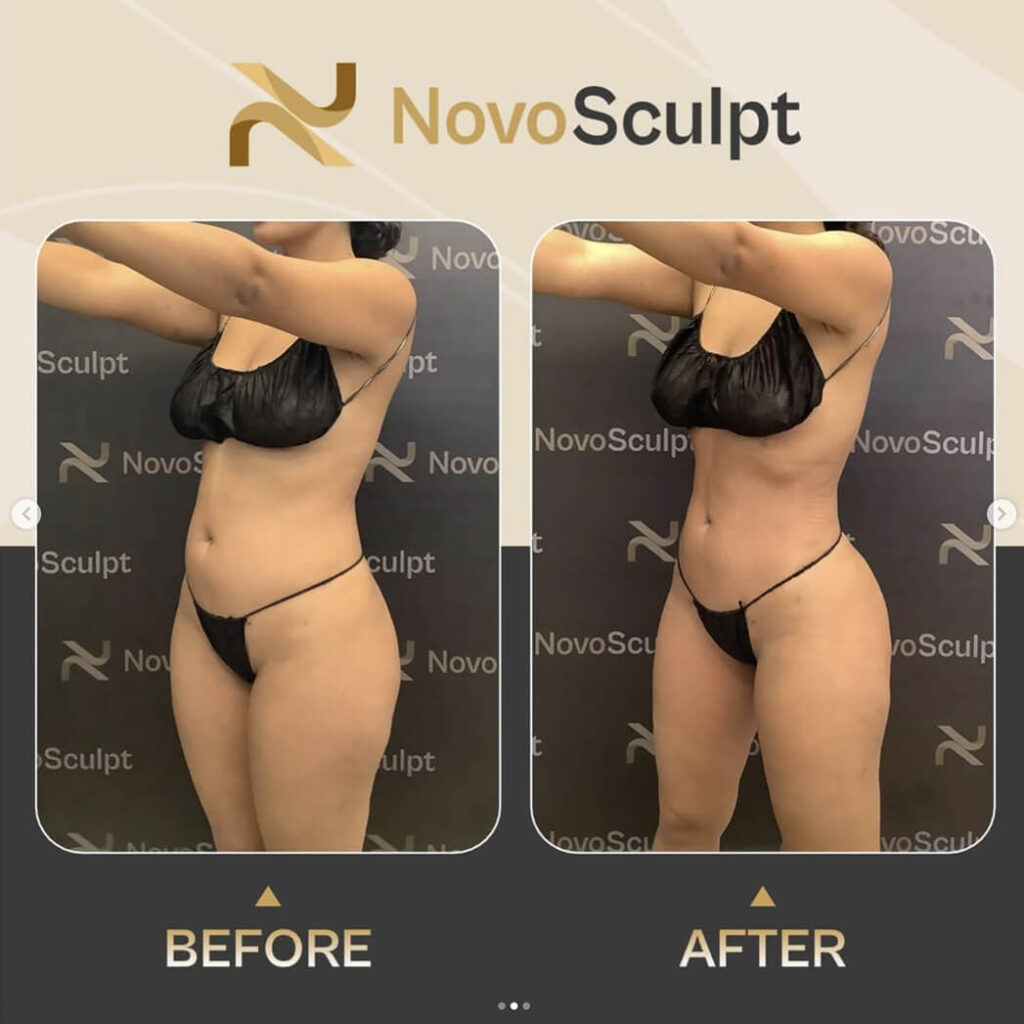 Before and After Fit