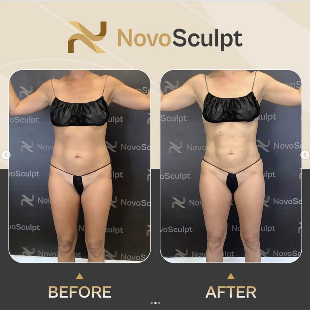 Before and After NovoSculpt