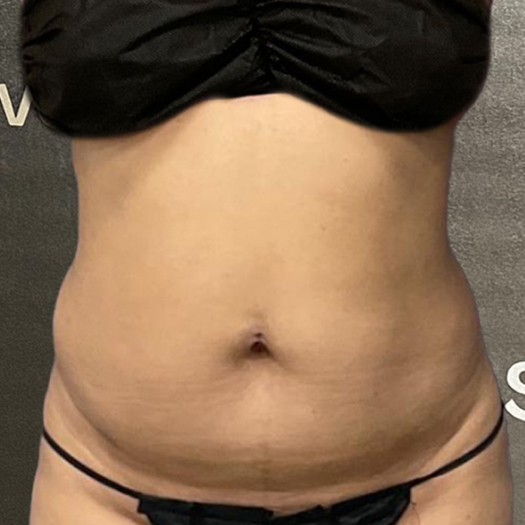 before-after-stomach-3-a Stomach before